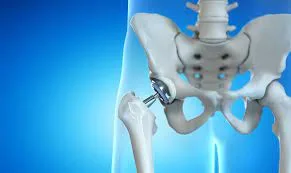 DAA vs Traditional Hip Replacement: What’s the Difference?
