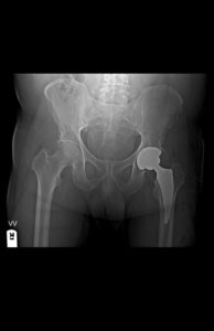 Direct Anterior Approach Hip Replacement Surgery