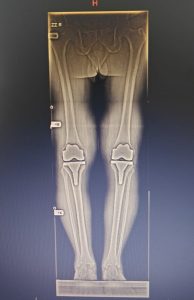 Robotic Knee Replacement Surgery