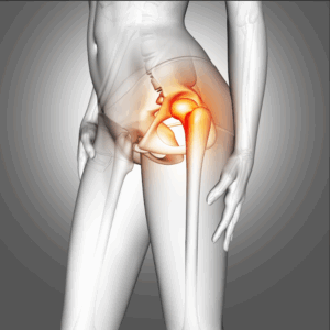 Knee or Hip Replacement