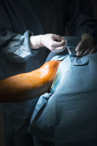 Best Knee Replacement Surgeon in Bangalore