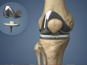 Knee Replacement 