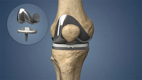 Bilateral Knee Replacement