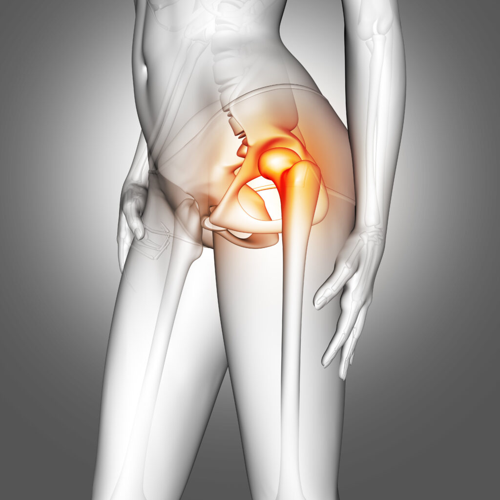 Anterior hip replacement illustration showing hip joint anatomy