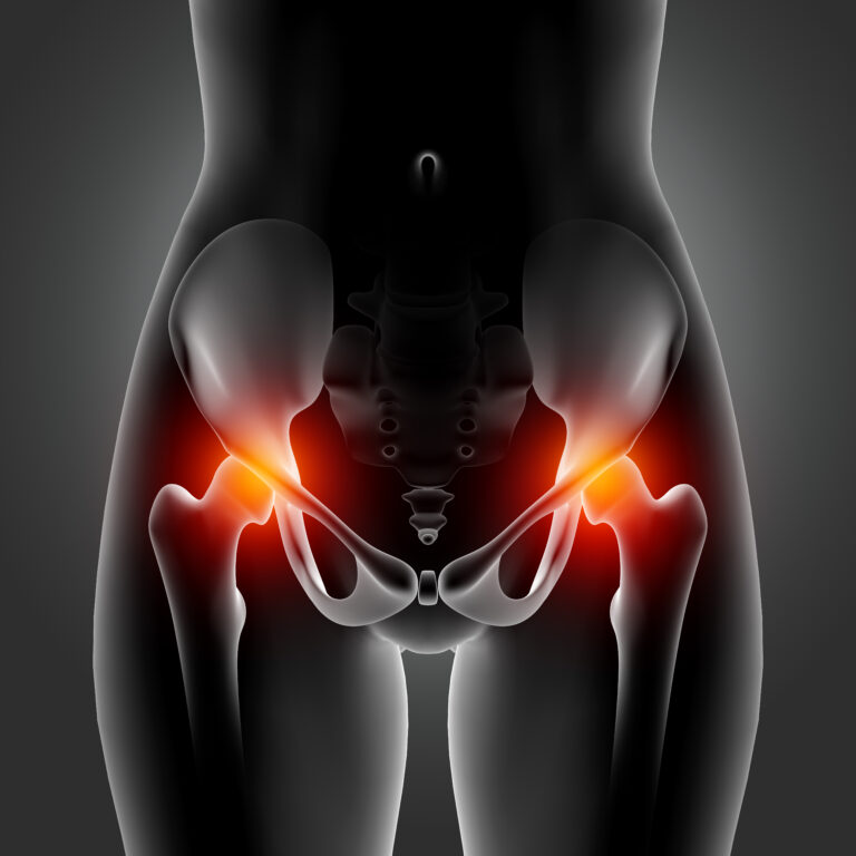 3D female medical figure with hip bones highlighted