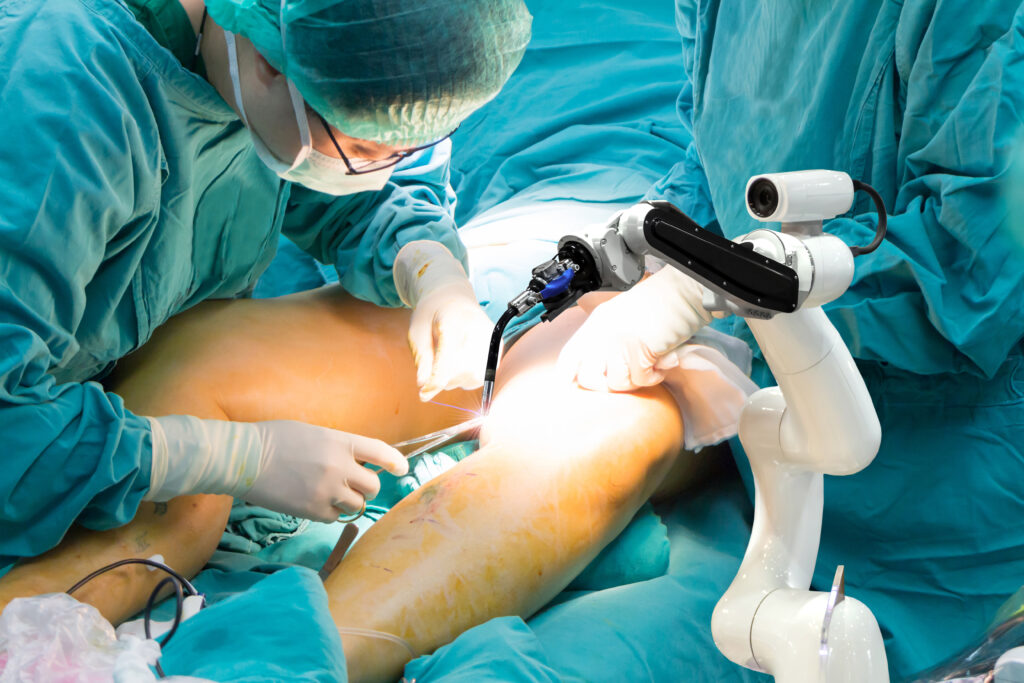 Robotic knee replacement surgery using advanced robotic-assisted technology